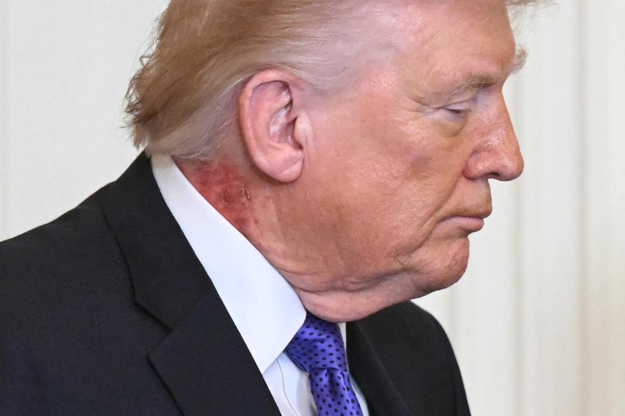 White House doctor explains cure for Donald Trump’s neck rash
